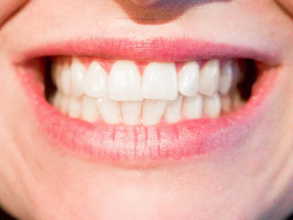 Whiten teeth for a beautiful smile like this lady
